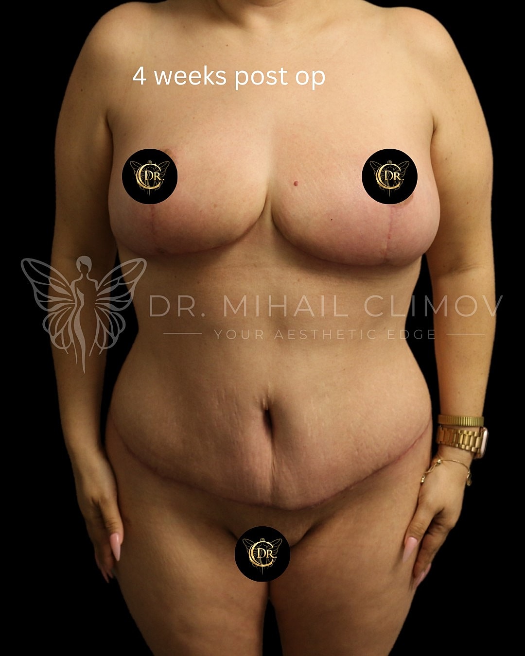 Case_011_front_after.png After mommy makeover results at 4 weeks post-op – front view – Dr. Mihail Climov, Aesthetic Plastic Surgeon, Houston, TX