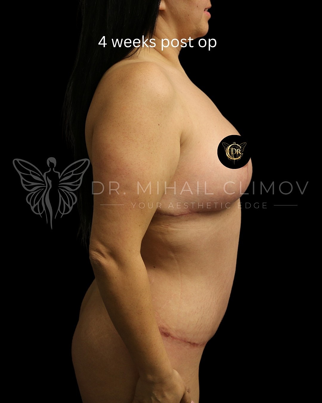 Case_011_right_after.png After mommy makeover results at 4 weeks post-op – right side profile view – Dr. Mihail Climov, Aesthetic Plastic Surgeon, Houston, TX
