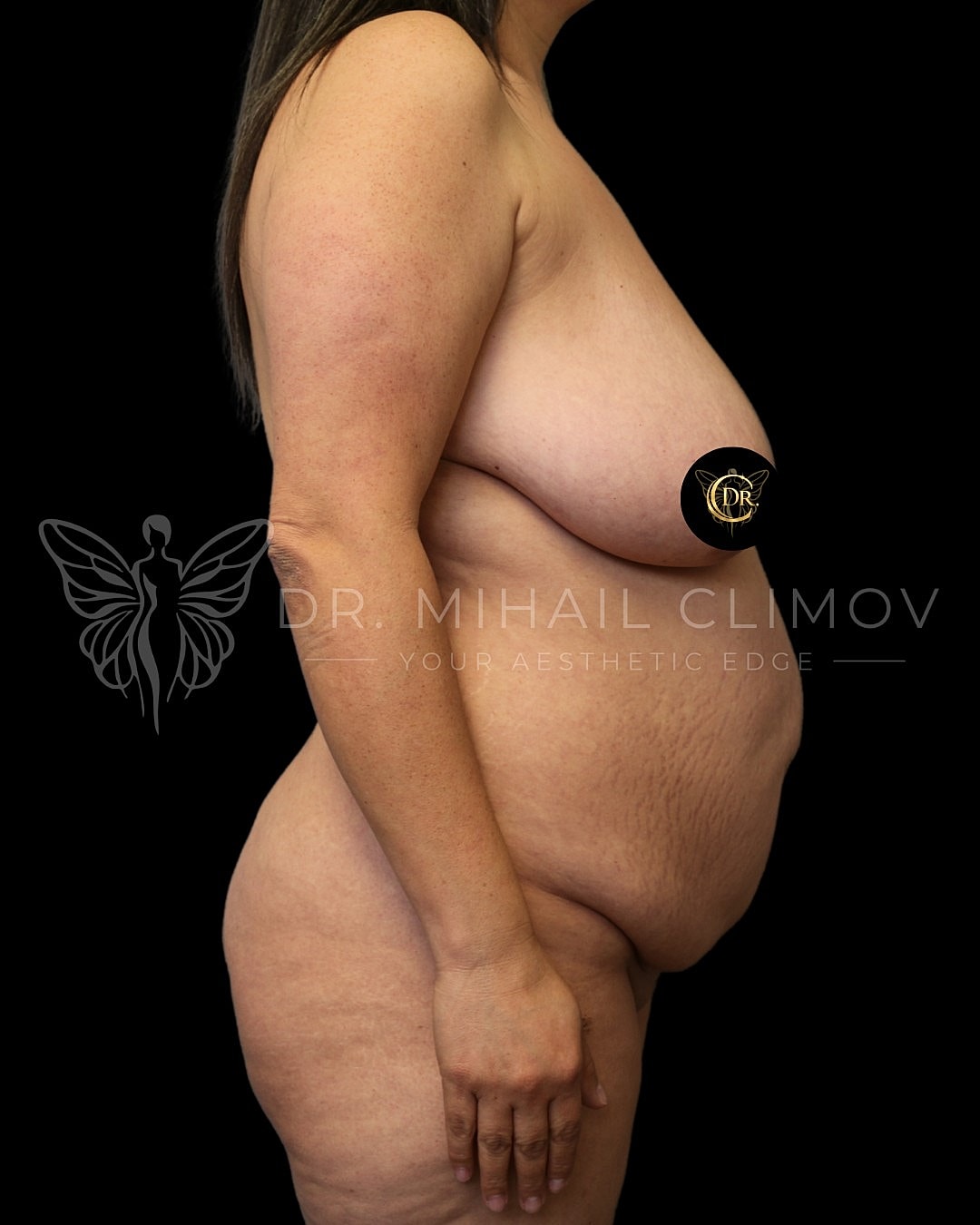 Case_011_right_before.png Before mommy makeover surgery – right side profile view – Dr. Mihail Climov, Aesthetic Plastic Surgeon, Houston, TX