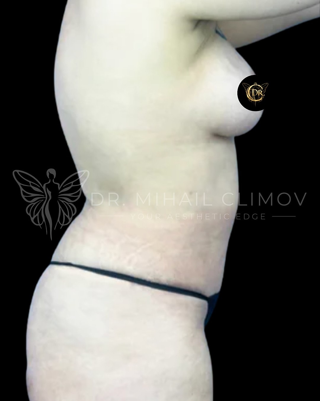 Profile view of a body with stretch marks.