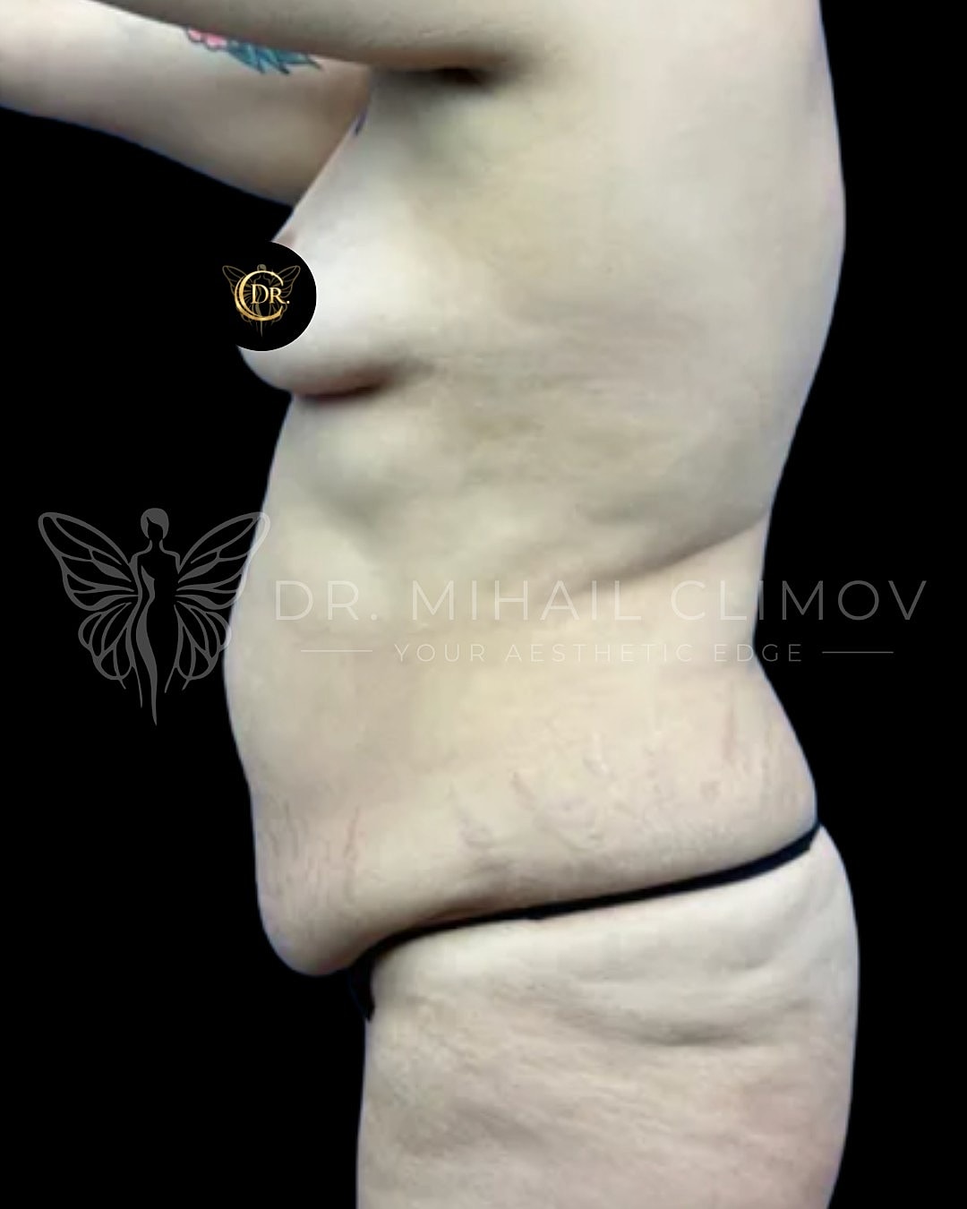 Side view of body with skin texture changes.