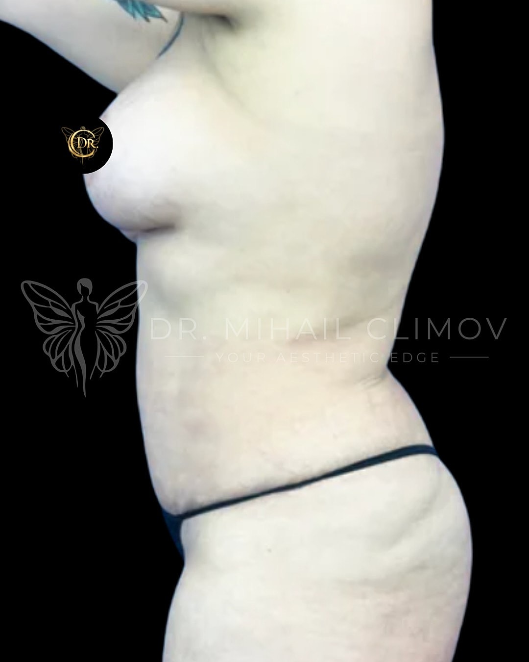 Side view of a person's torso and abdomen.