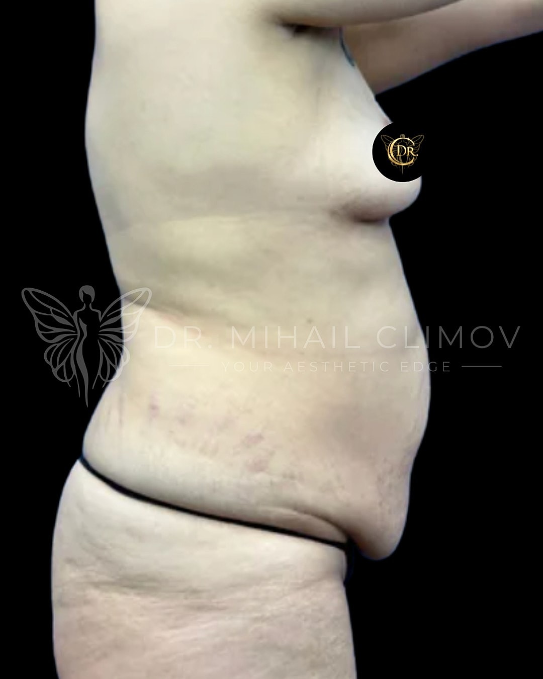 Profile view of abdomen with skin texture visible.