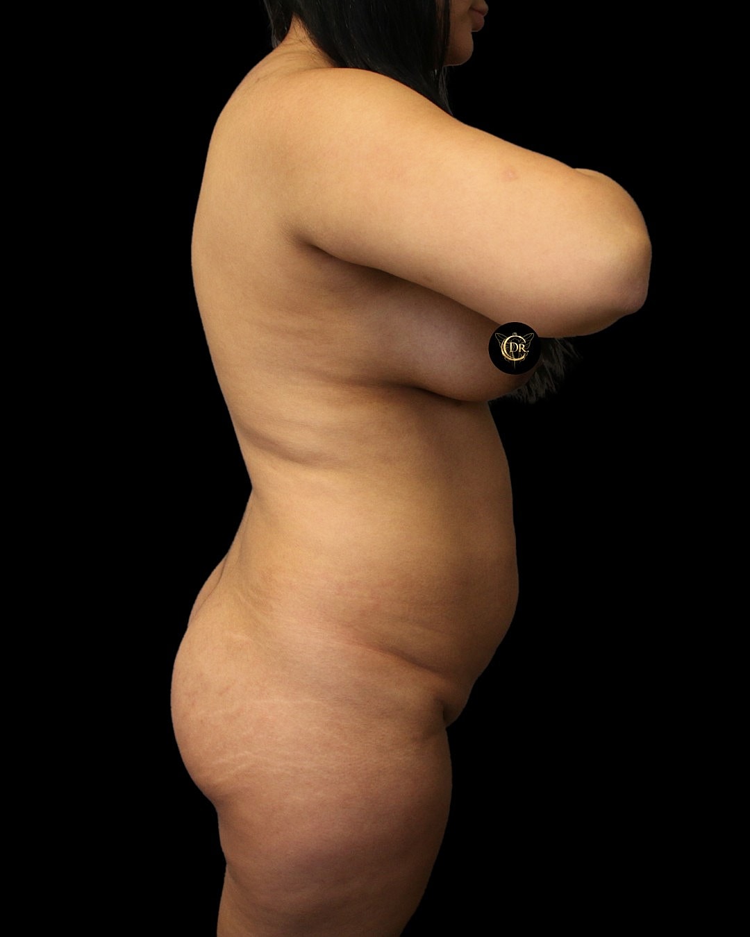 360 liposuction and breast lift before and after