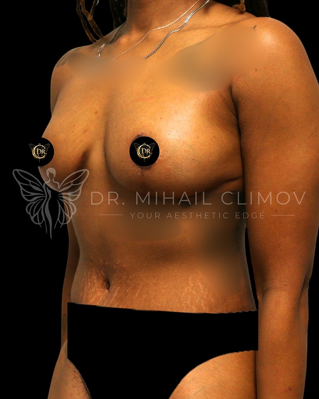 Mommy MakoverDr. Mihail Climov, Aesthetic Plastic Surgeon, Houston, TX