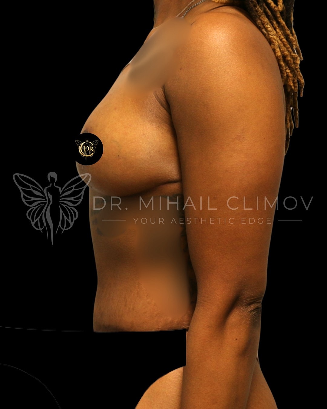 Mommy MakoverDr. Mihail Climov, Aesthetic Plastic Surgeon, Houston, TX