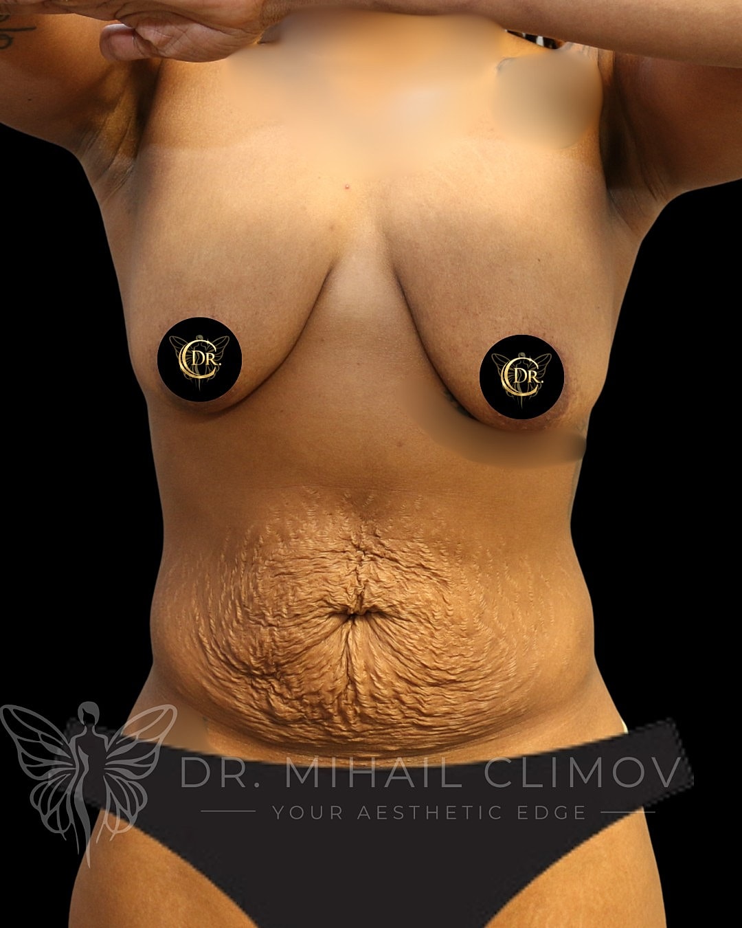 Case_008_Before_front.png Before mommy makeover surgery – front view – Dr. Mihail Climov, Aesthetic Plastic Surgeon, Houston, TX