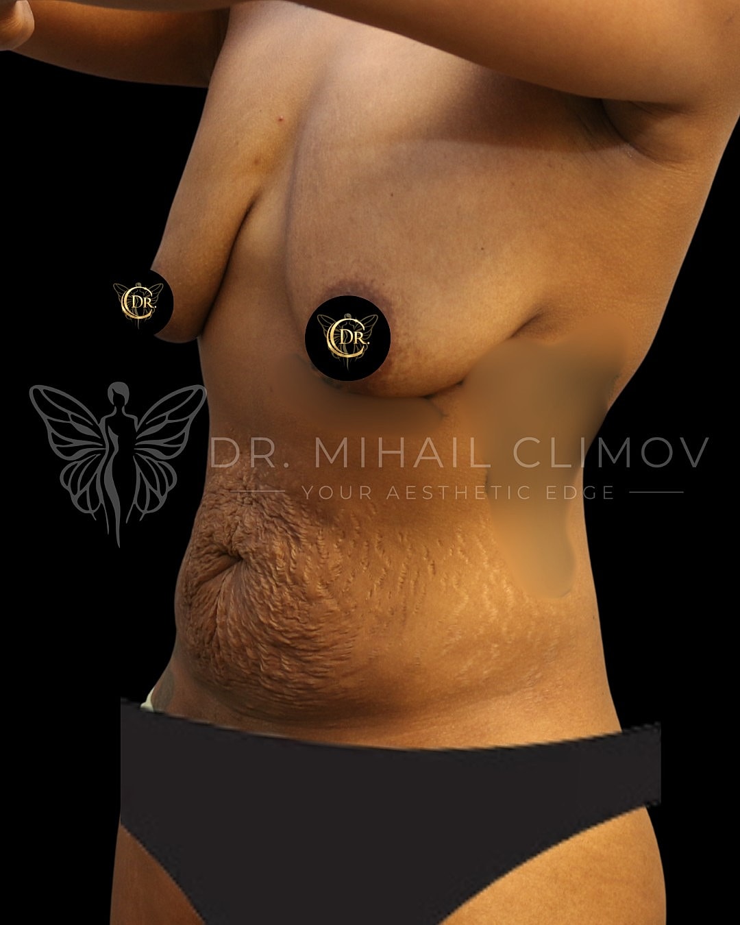Mommy MakoverDr. Mihail Climov, Aesthetic Plastic Surgeon, Houston, TX