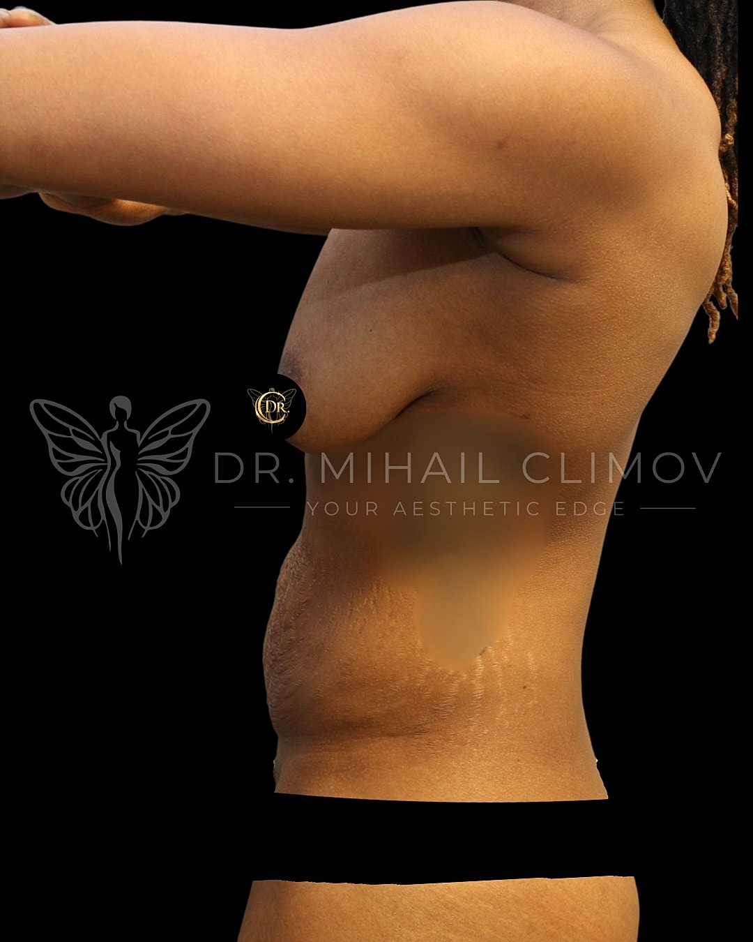Mommy MakoverDr. Mihail Climov, Aesthetic Plastic Surgeon, Houston, TX