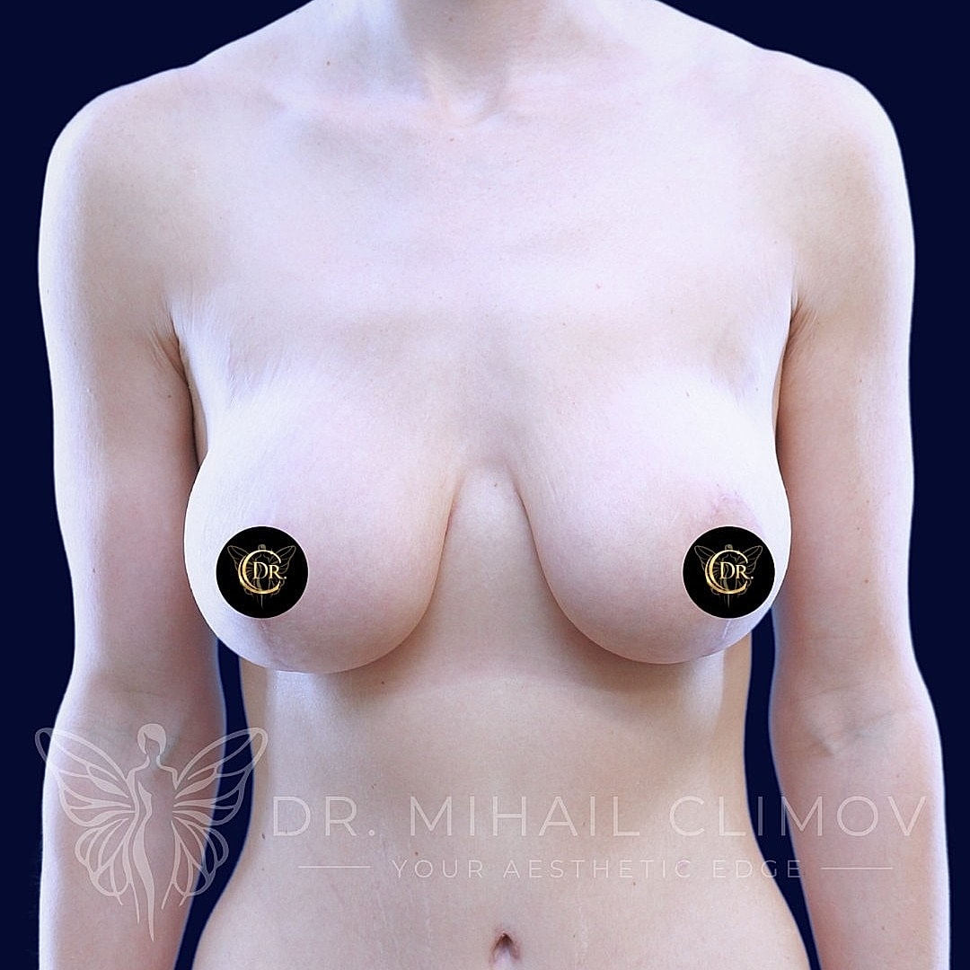 Breast Augmentation and Lift Before & After