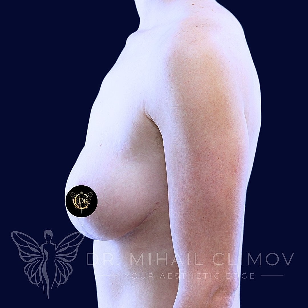 Breast Augmentation and Lift Before & After