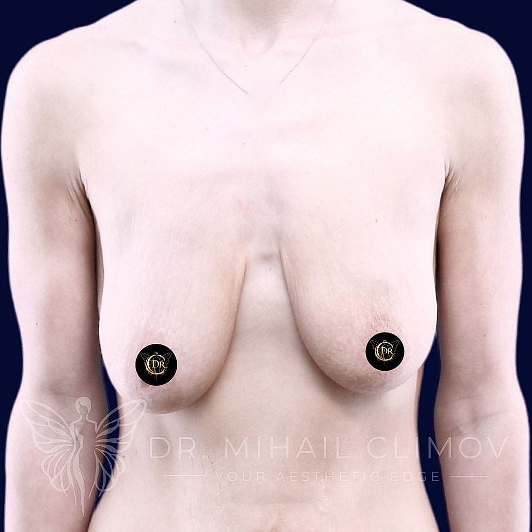 Breast Augmentation and Lift Before & After