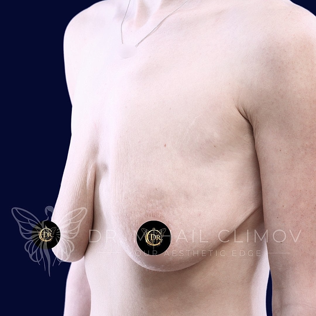 Breast Augmentation and Lift Before & After