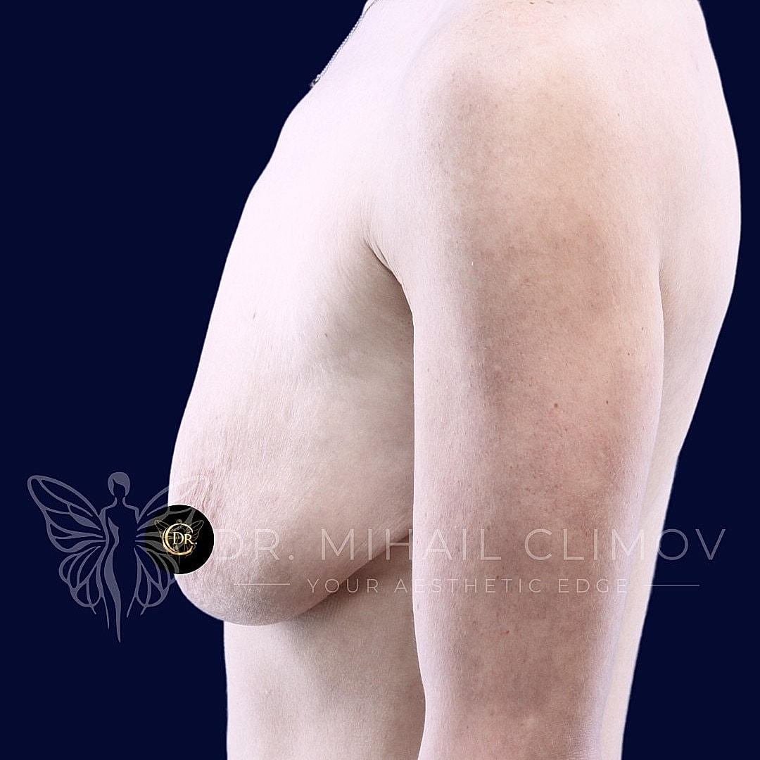 Breast Augmentation and Lift Before & After