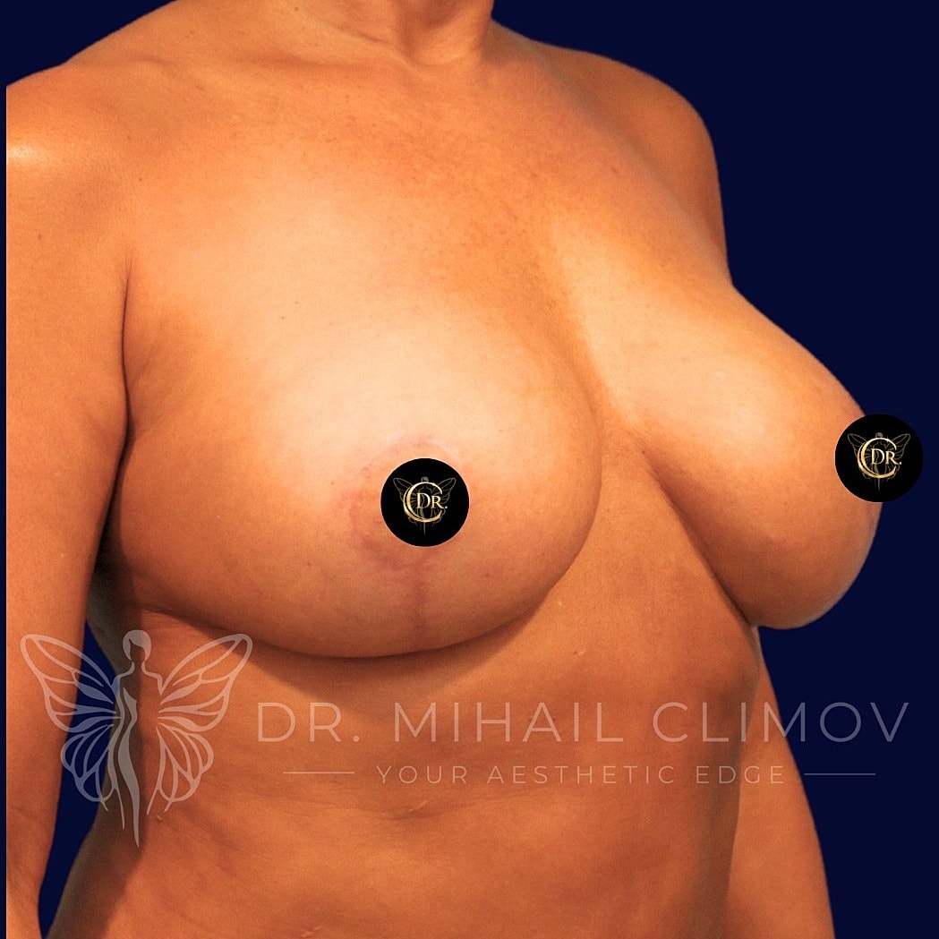 Breast Augmentation and Lift Before & After