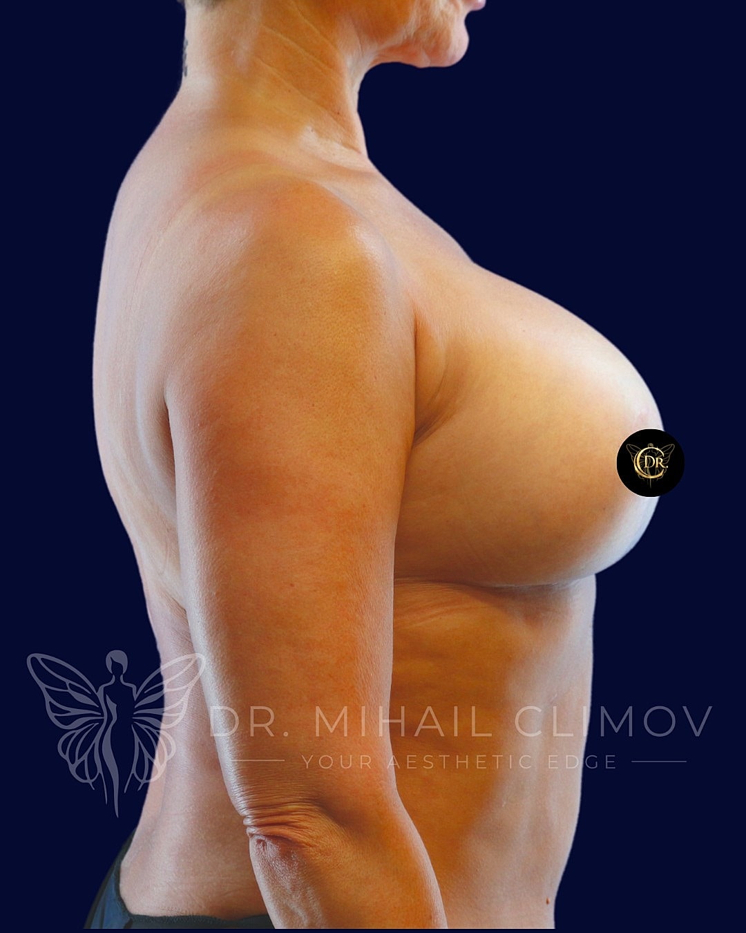 Breast Augmentation and Lift Before & After