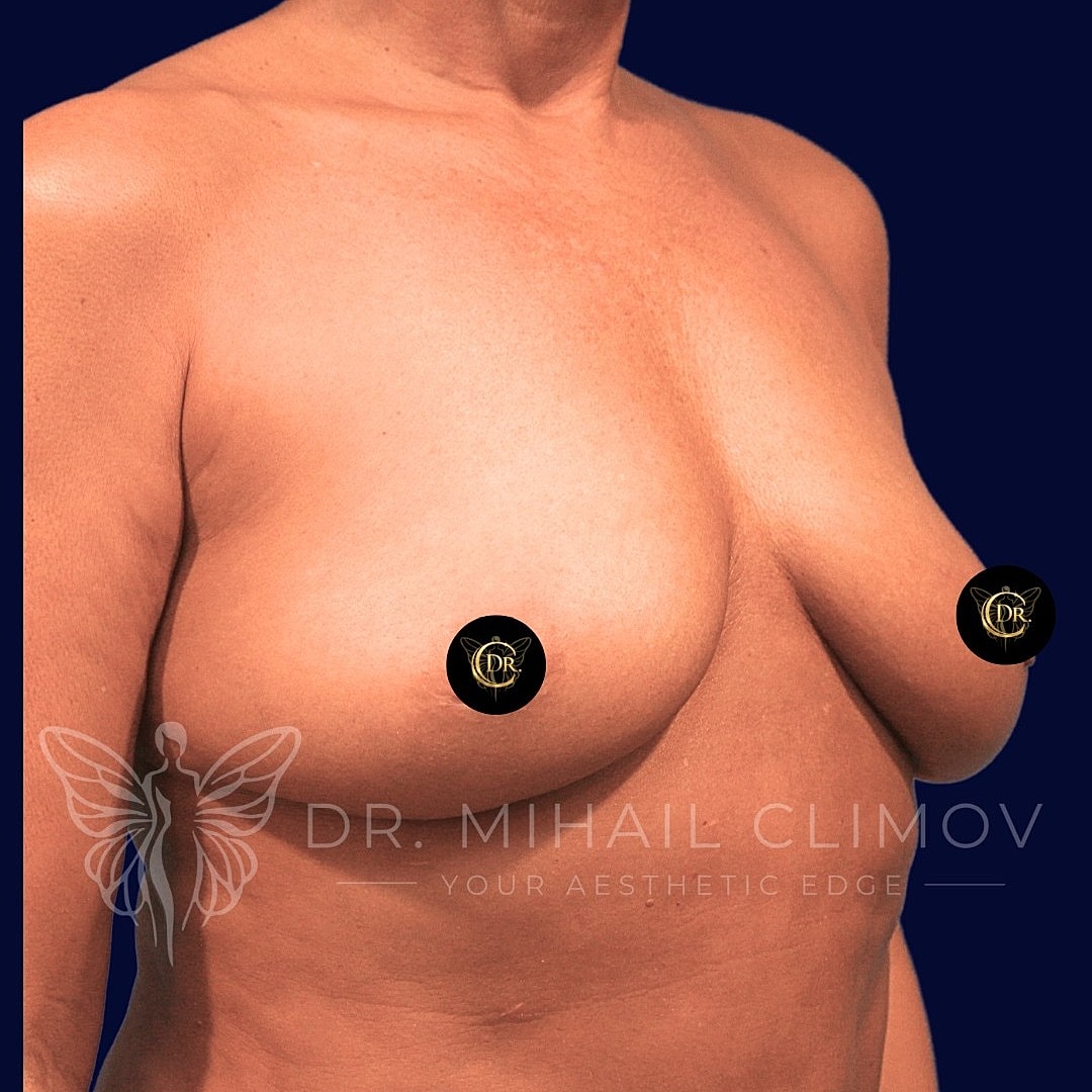 Breast Augmentation and Lift Before & After