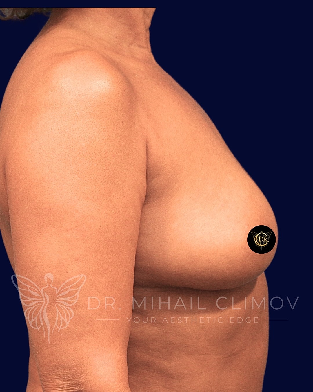 Breast Augmentation and Lift Before & After