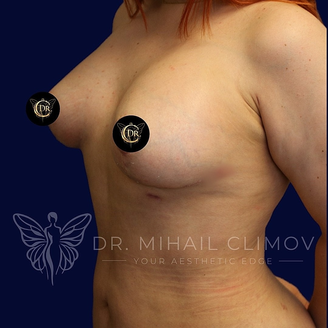 Breast Augmentation and Lift Before & After
