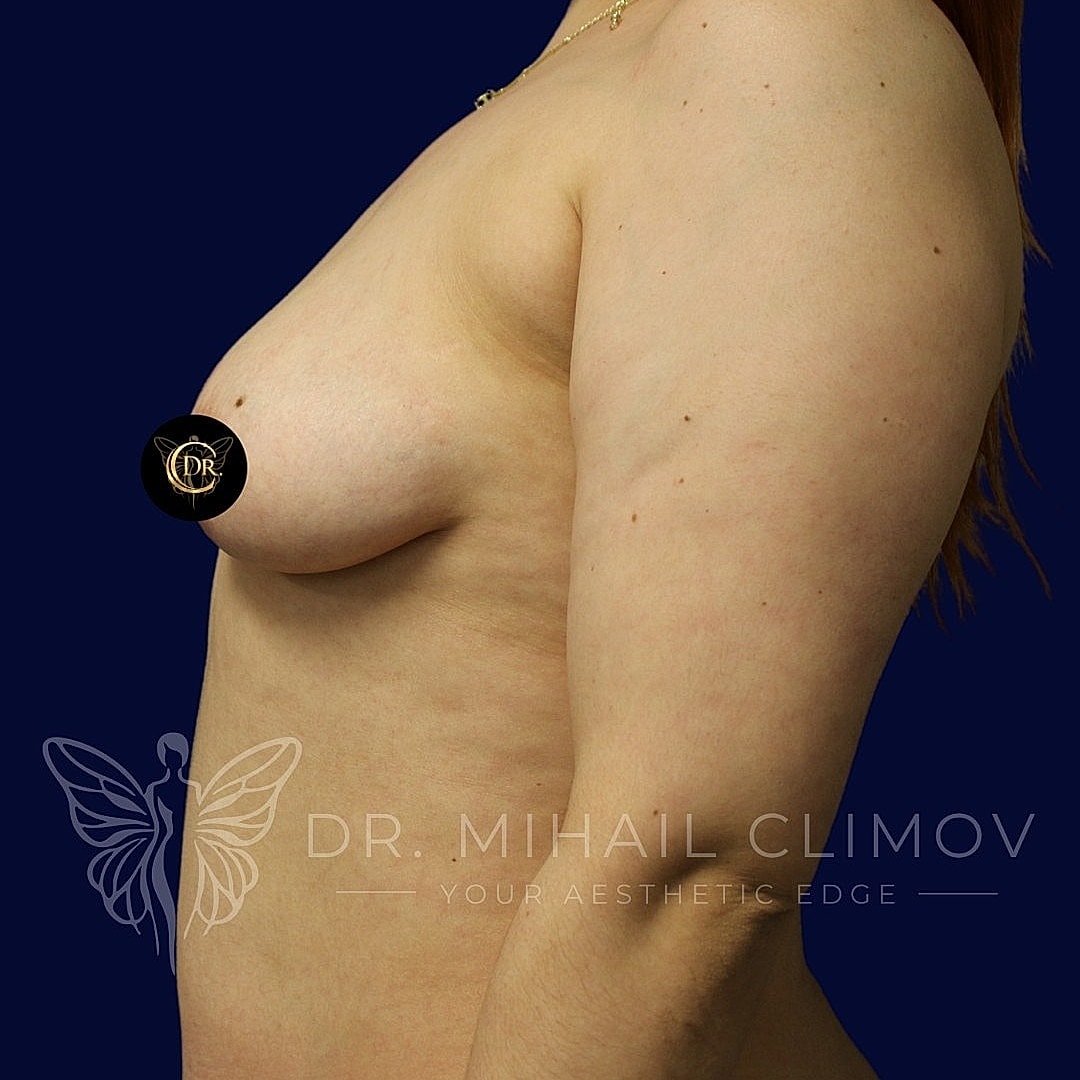 Breast Augmentation and Lift Before & After
