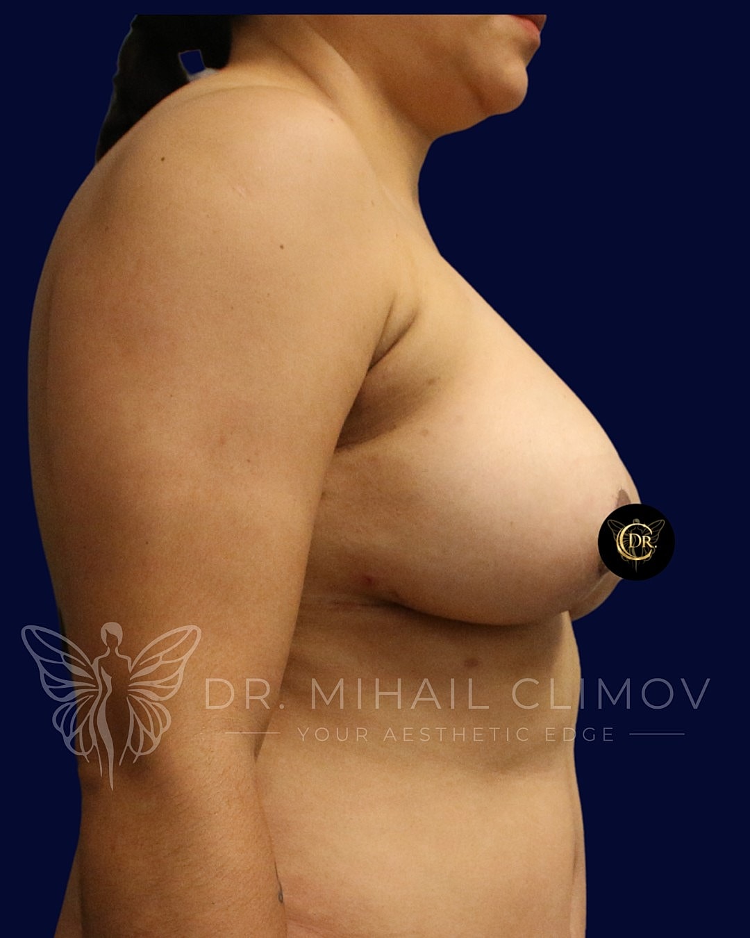 Breast Augmentation and Lift Before & After