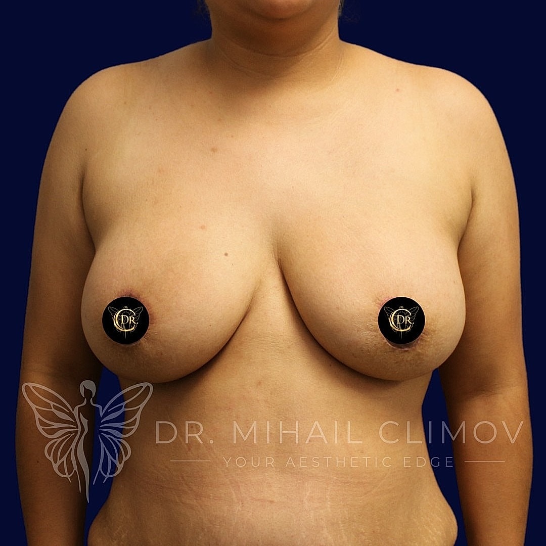 Breast Augmentation and Lift Before & After