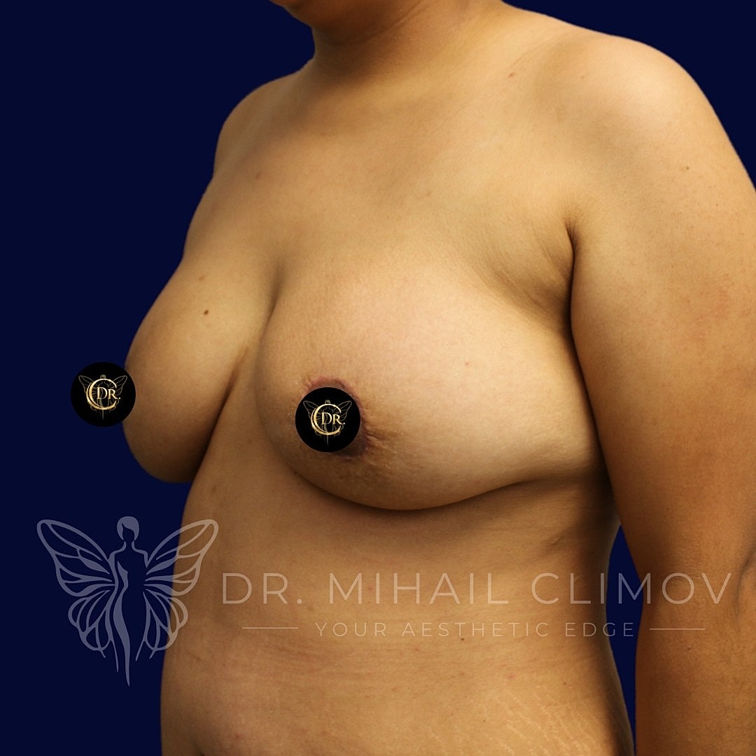 Breast Augmentation and Lift Before & After