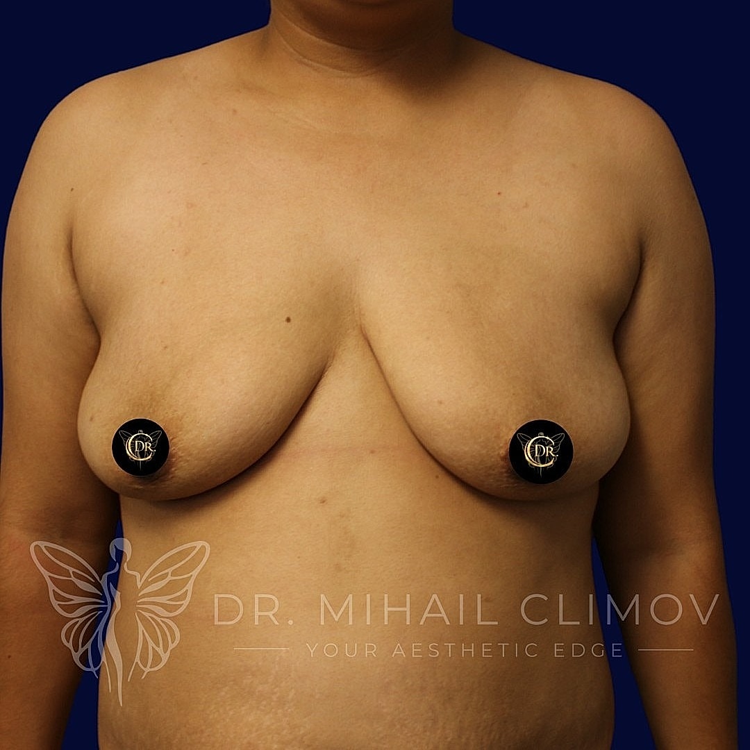 Breast Augmentation and Lift Before & After