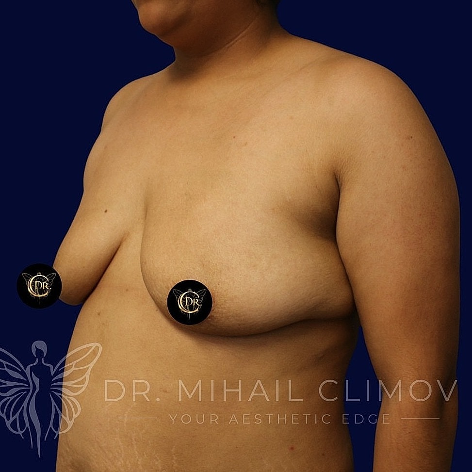 Breast Augmentation and Lift Before & After