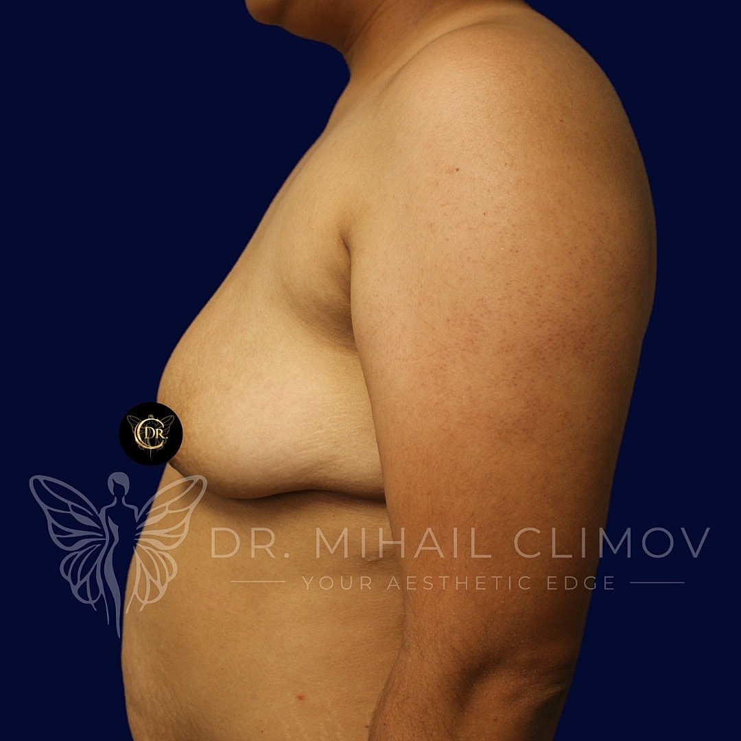 Breast Augmentation and Lift Before & After