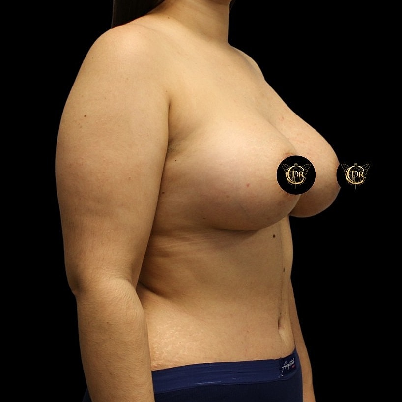 Dr. Mihail Climov breast lift and augmentation results