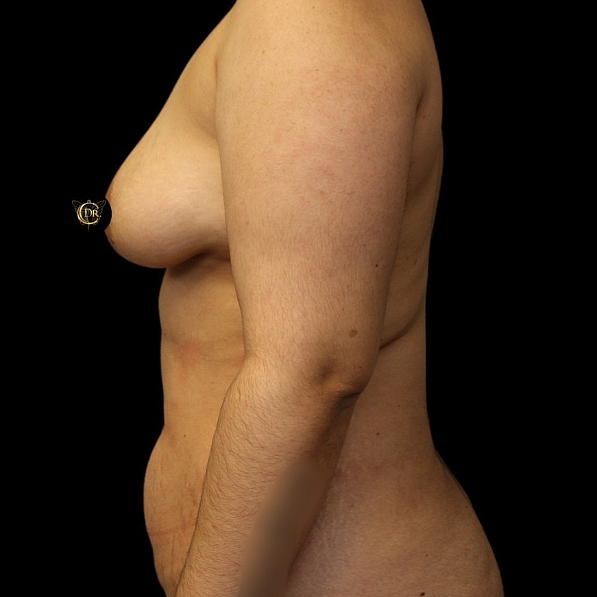 Dr. Mihail Climov breast lift and augmentation results