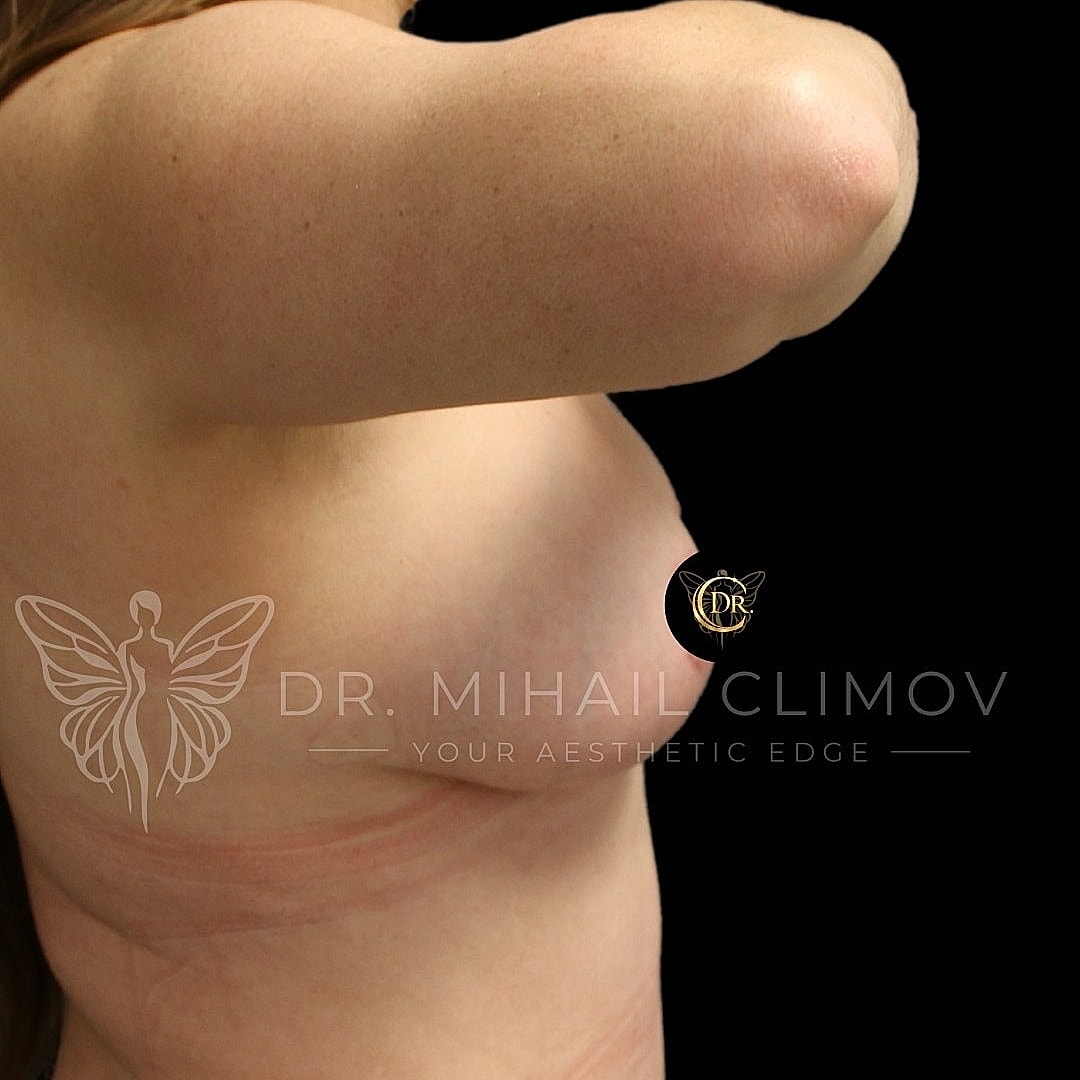 Breast Augmentation and Lift Before & After