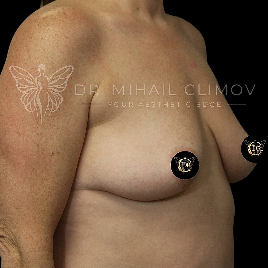 Breast Augmentation and Lift Before & After