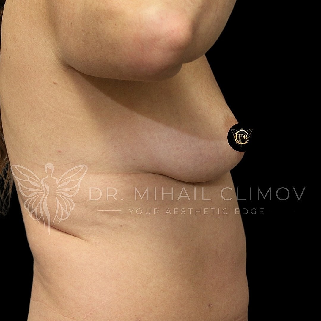 Breast Augmentation and Lift Before & After