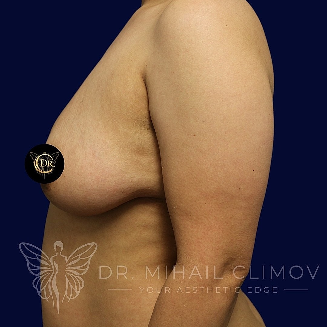 Breast Augmentation and Lift Before & After