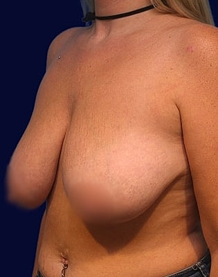 Breast Reduction Before & After