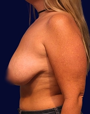 Breast Reduction Before & After