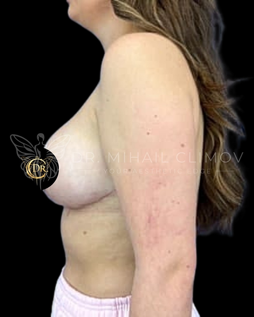 _after_left.png After breast reduction results – left side profile view – Dr. Mihail Climov, Aesthetic Plastic Surgeon, Houston, TX