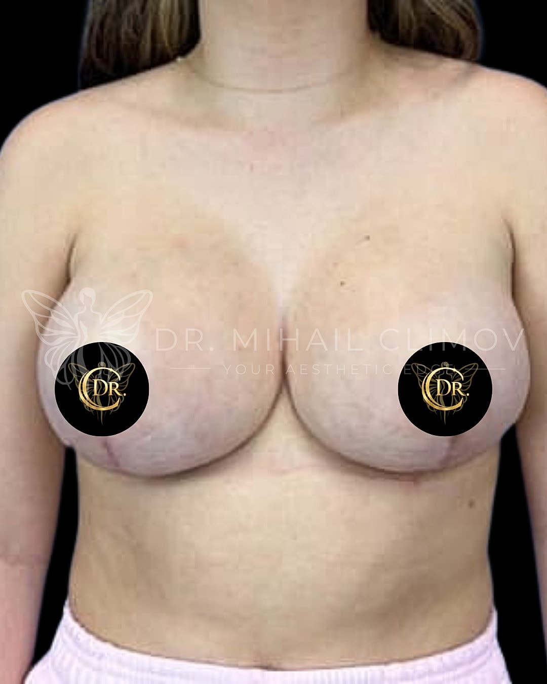 _after_front.png After breast reduction results – front view – Dr. Mihail Climov, Aesthetic Plastic Surgeon, Houston, TX