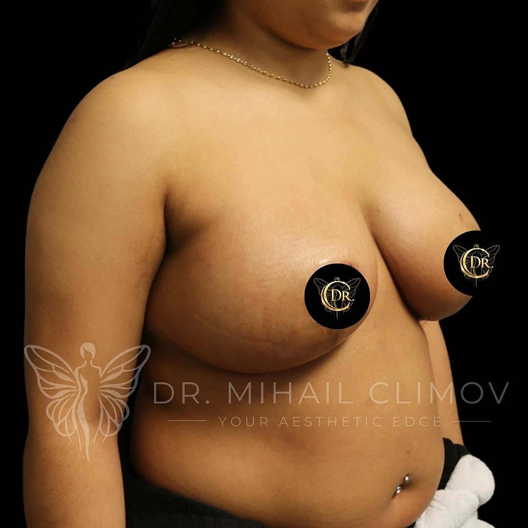 Breast Reduction Before & After