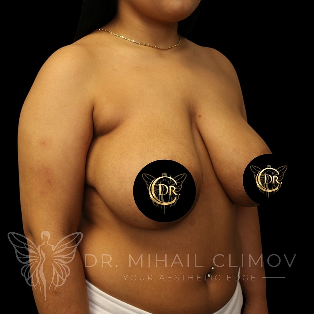 Breast Reduction Before & After