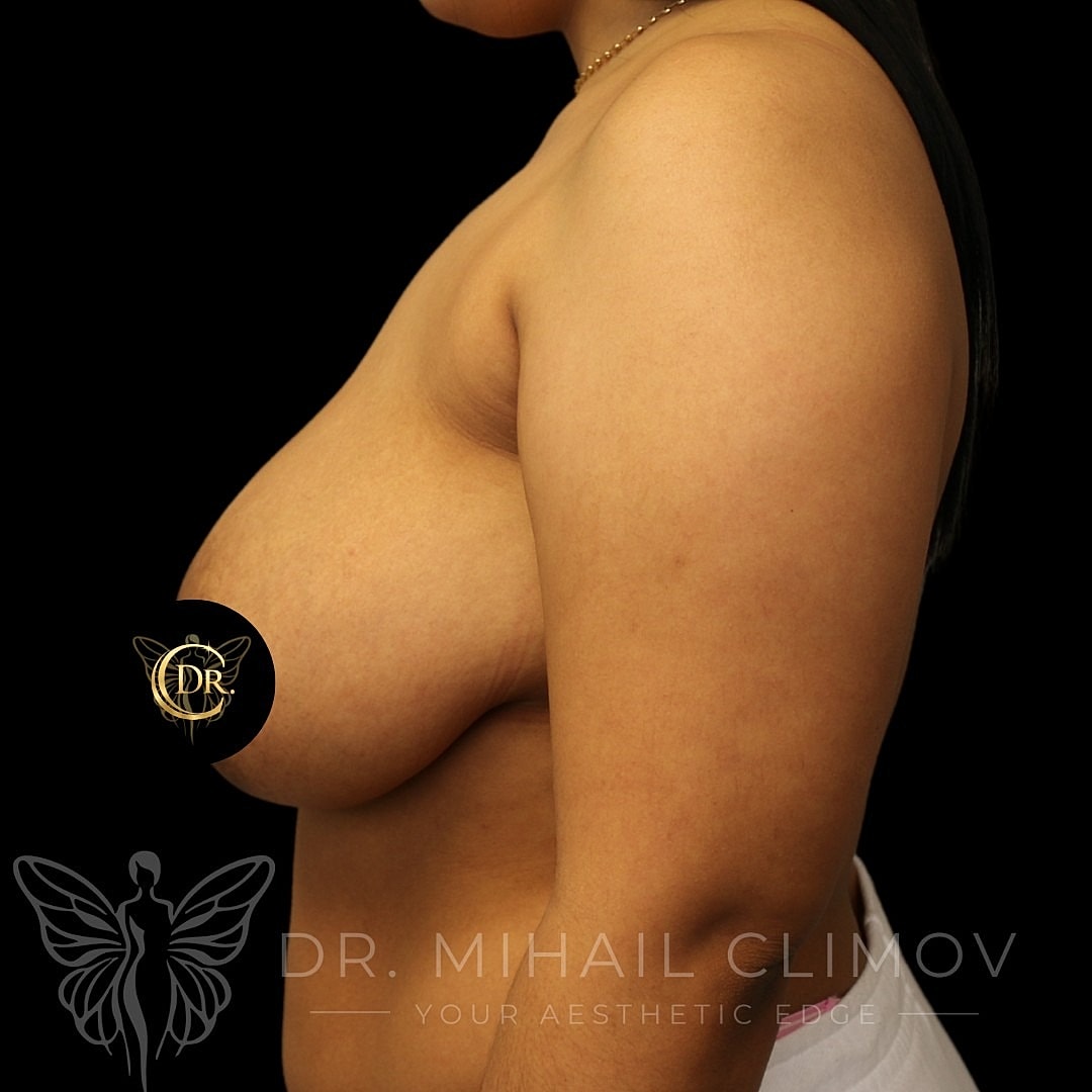 Breast Reduction Before & After