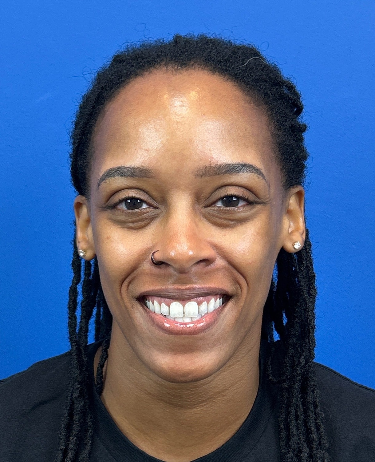 Lower Blepharoplasty Before & After