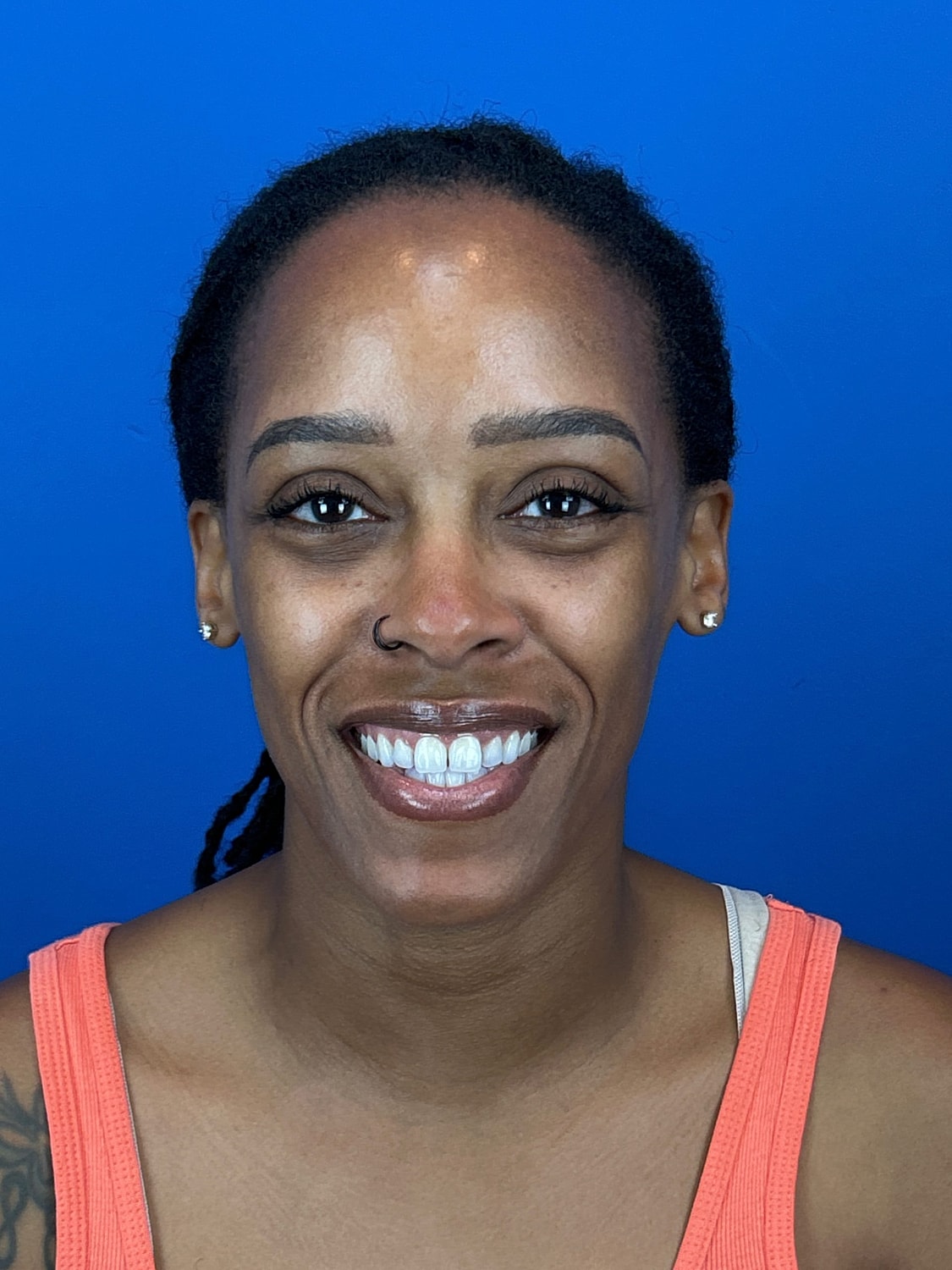 Lower Blepharoplasty Before & After