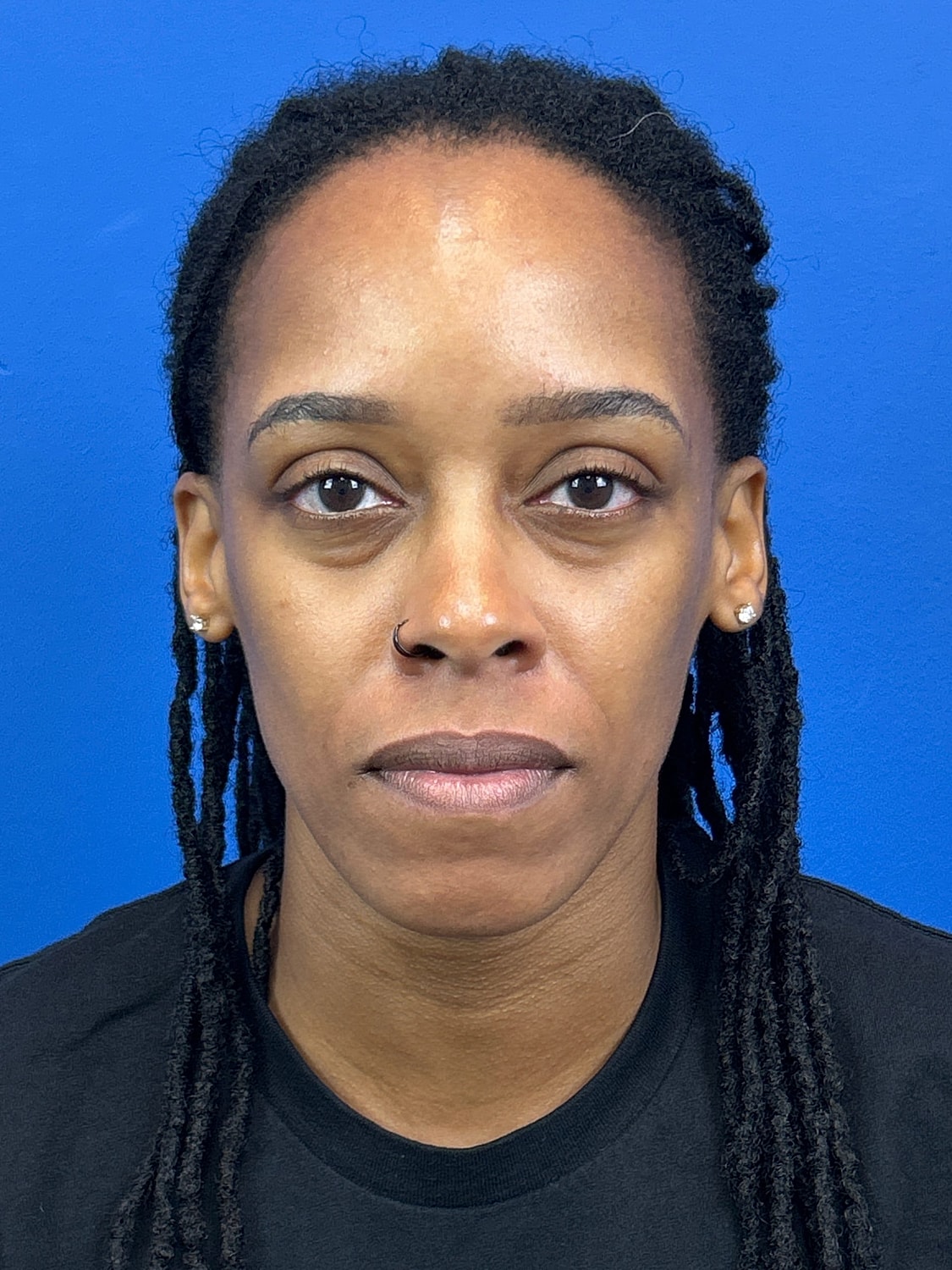 Lower Blepharoplasty Before & After