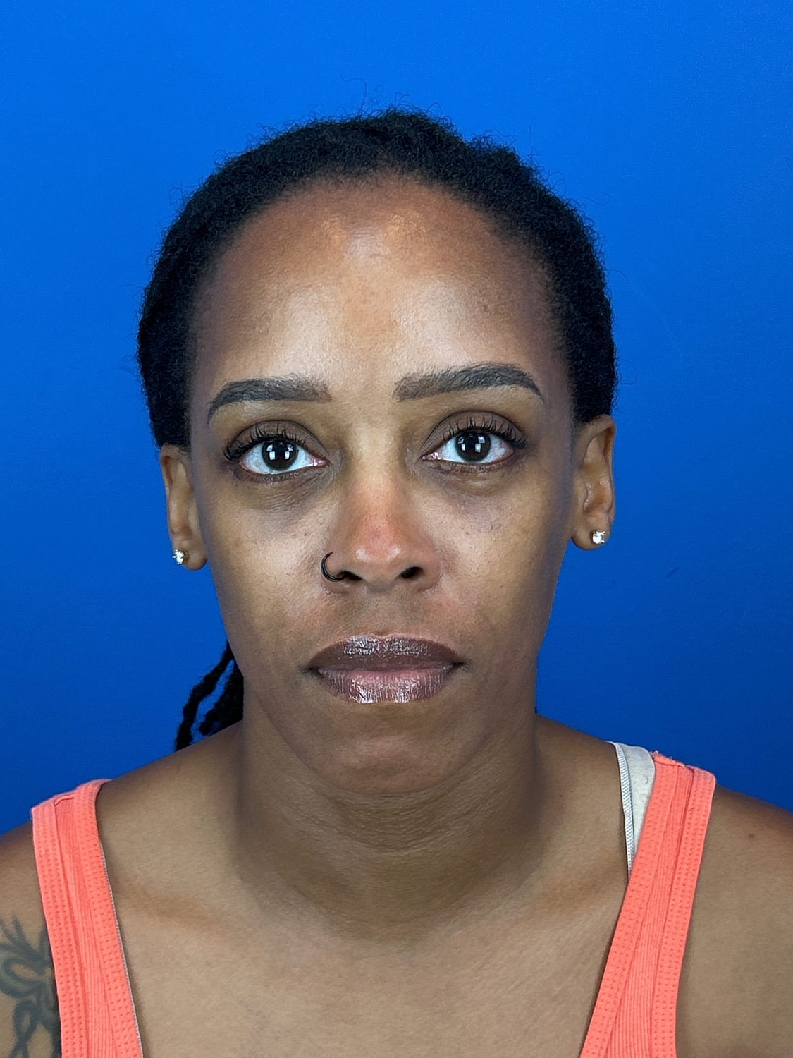 Lower Blepharoplasty Before & After