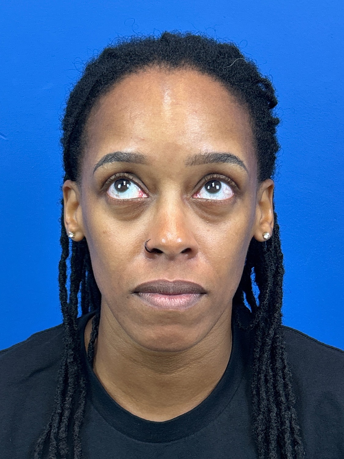 Lower Blepharoplasty Before & After