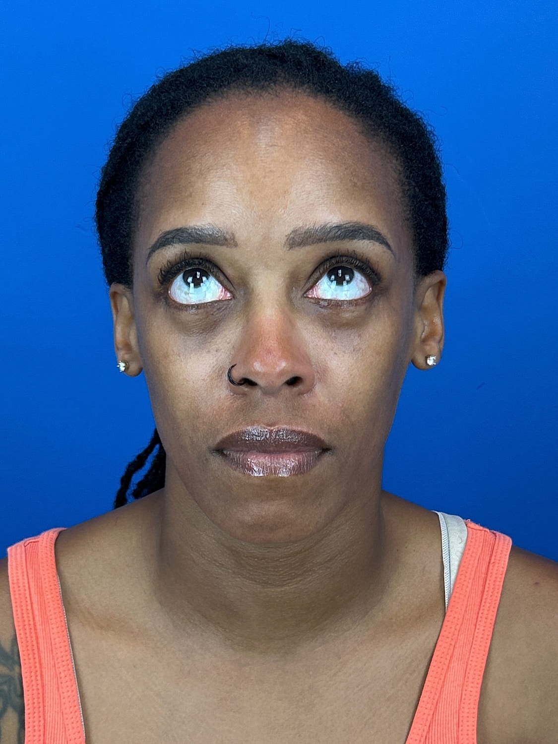 Lower Blepharoplasty Before & After