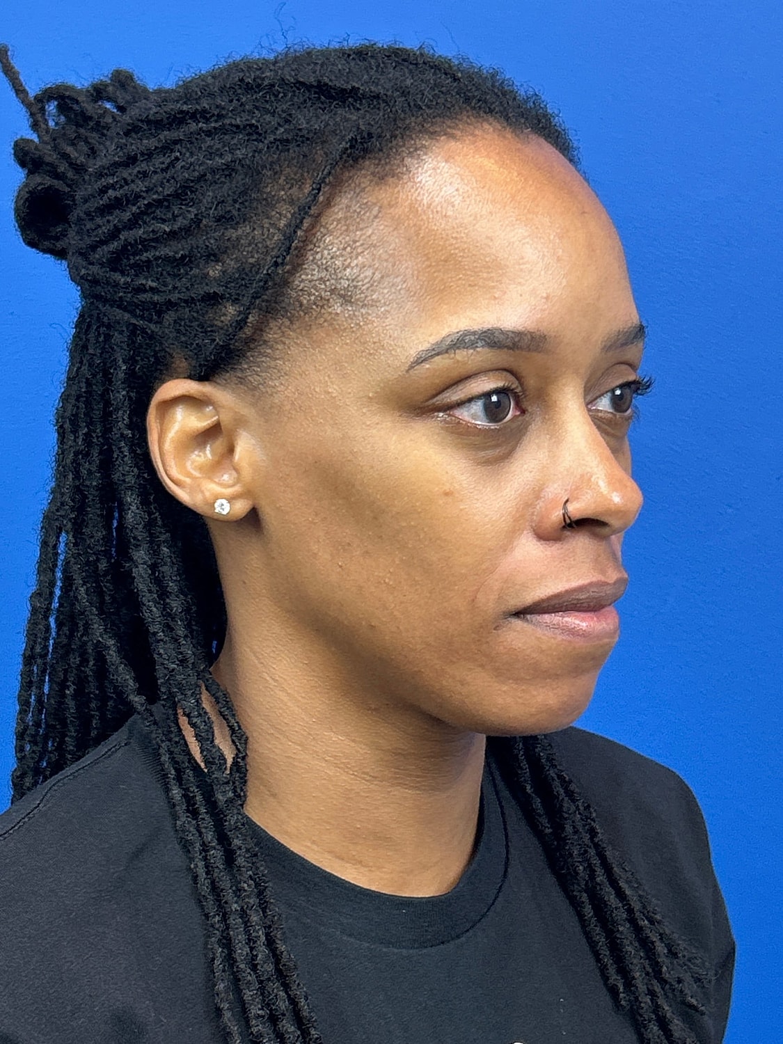 Lower Blepharoplasty Before & After